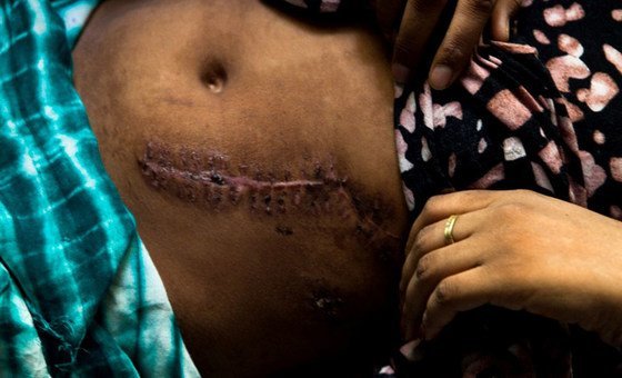 After a short, informal marriage, a transient 15-year-old Ethiopian girl was severely stabbed when the man who had deserted her after promising to see her to Yemen, flew into a jealous rage. After a short, informal marriage, a transient 15-year-old Ethiopian girl was severely stabbed when the man who had deserted her after promising to see her to Yemen, flew into a jealous rage.