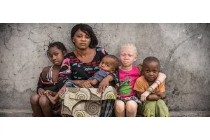Making education safe for children with albinism in Malawi | UN News