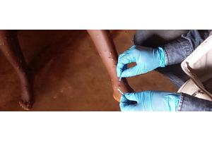 Mpox: What you need to know about the latest public health emergency | UN News