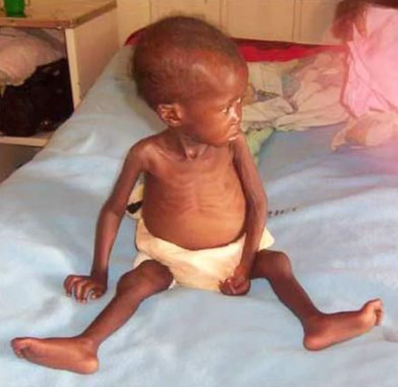 Malnourished_child Malnourished_child