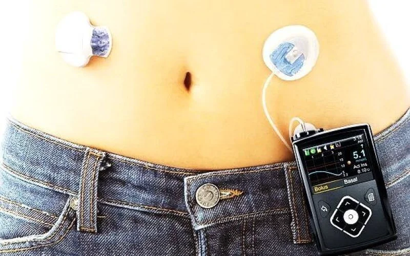 Continuous glucose monitoring devices have been used by those with diabetes, can they help with general weight loss? Credit: Zheng Guanglou et. al. via Medtronic