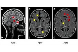 Revolutionary AI Identifies Hidden Brain Abnormalities in Epileptic Children