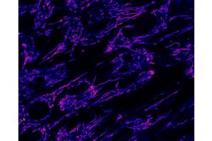 Rare Childhood Metabolic Crises Explained by Fat Transport Deficiency