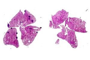 Aspirin’s Potential: New Insights Into Its Role in Hindering Cancer Metastasis