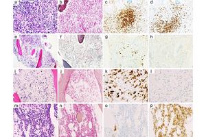 Refining Classification of Pediatric Bone Marrow Myelofibrosis: Understanding Its Heterogeneity to Improve Treatment Strategies