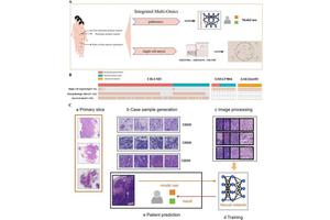 Revolutionary AI Innovations Enhance Neuroblastoma Diagnosis and Predict Bone/Bone Marrow Metastasis
