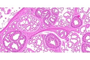 Hepatic Biliary Adenofibroma: Key Histological Features, Diagnostic Hurdles, and Its Potential as a Precursor to Intrahepatic Cholangiocarcinoma