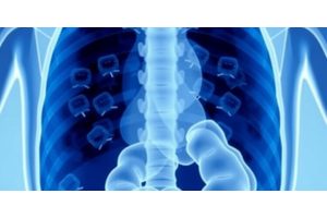 Cleveland Clinic Unveils Predictive Tool for Assessing Early-Onset Colorectal Cancer and Precancerous Polyp Risks