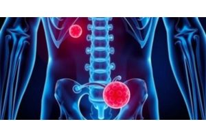 Breakthrough Research Offers Hope for Curing Recurring Urinary Tract Infections