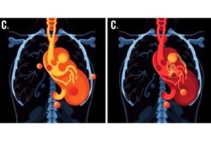 Impact of Integrating Coronary Calcium Scores with Treatment Strategies on Plaque Development in Familial Coronary Artery Disease