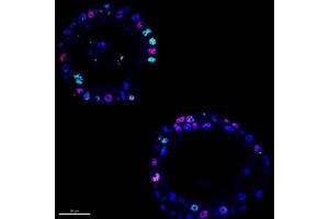 Unveiling the Hidden DNA Circles Driving the Aggressiveness of Pancreatic Cancer