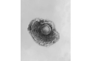 Awakening Threat: The Role of VZV Reactivation in Central Nervous System Infections