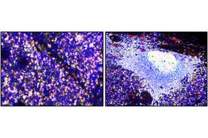Breakthrough Discovery: Researchers Uncover Dysfunctional B Cells as a Novel Target for Cancer Immunotherapy