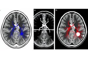Assessing the Diagnostic Potential of Vascular Architecture in Solitary Pulmonary Nodules Through Dynamic Contrast-Enhanced MRI