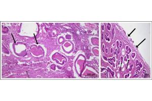 Uncommon Uterine Condition Resembles Cancer Symptoms in Postmenopausal Women