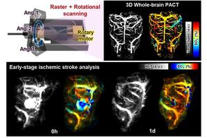 Advancements in Stroke Detection: Harnessing Light and Sound for Real-Time Monitoring