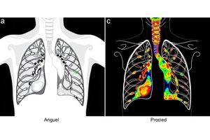 Exploring Morphomic Predictors: Insights into Post-Esophagectomy Pulmonary Complications and Overall Survival