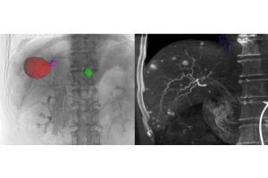 Experts Reach Consensus on Cone-Beam CT Utilization in Interventional Liver Cancer Treatments