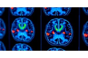 Breakthrough Test Pinpoints High-Risk Childhood Brain Tumors, Enhancing Treatment Strategies