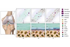 Breakthroughs in Artificial Ligaments Transform ACL Reconstruction: A Step Forward for Enhanced Patient Outcomes