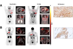 New Radiotracer Uncovers Biomarker Associated with Triple-Negative Breast Cancer