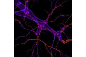 Functional Synapses Link Neurons and Lung Cancer