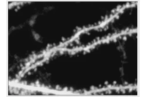 Promising Molecular Approach Emerges for Treating Fragile X Syndrome