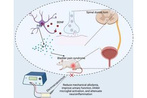 Innovative Treatment Approaches Emerging for Neglected Bladder Disorder