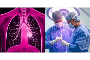 Influence of Corticosteroid Treatment Length on Postoperative Acute Lung Injury After Lung Cancer Surgery