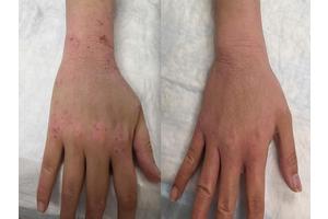 NIH Researchers Establish Diagnostic Criteria for Topical Steroid Withdrawal