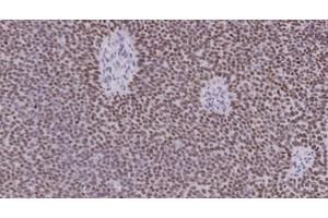 Scientists Identify Early Indicator of Prostate Cancer Aggressiveness