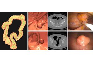 CT colonography outperforms stool DNA testing in colon cancer screening, new study reveals