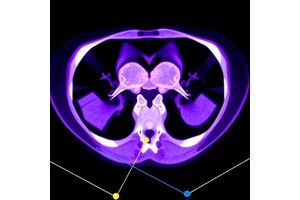 Deep Learning Enhances PET/CT Analysis in Endometrial Cancer