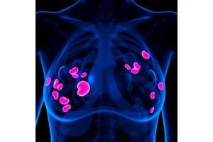 Targeting Trophoblast Antigen in Triple-Negative Breast Cancer