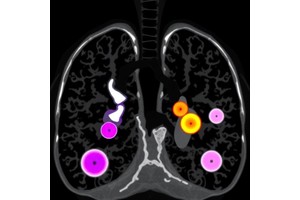How Respiratory Phase Influences 3D Quantitative Analysis of Pulmonary Subsolid Nodules in Low-Dose CT Lung Cancer Screening
