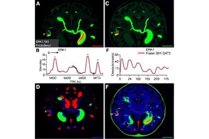 ERK1 Phosphorylation Boosts Fructolysis in Glioblastoma
