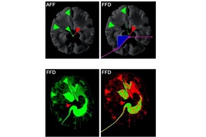 FGFR Inhibition Boosts Glioblastoma Stem Cell Sensitivity
