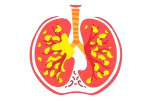 Early Radiotherapy Boosts Survival in Extensive-Stage SCLC