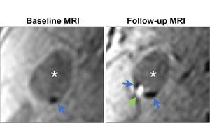 Carotid Plaque: A Growing Threat to Vascular Health Over Time
