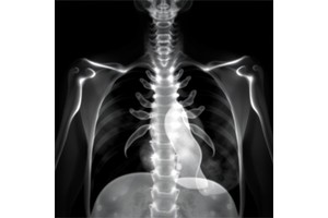 Rethinking Male Risk in Bronchopulmonary Dysplasia
