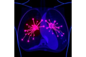 Dual-Laser Approach Transforms Breast Cancer Photothermal Therapy