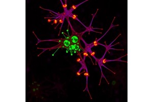 Intracellular Amyloid-ß Marks Vulnerable Neurons in Alzheimer’s