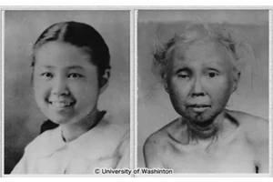 Breakthrough Advances Bring New Hope to Werner Syndrome Patients