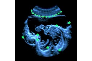 Real-Time Ultrasound Holography via Thermographic Imaging