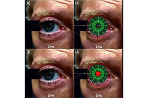 Automated Eyelid Movement Analysis in Early Parkinson’s