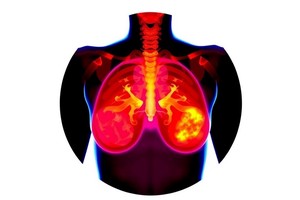 Radiation Therapy Benefits in HER2+ Breast Cancer